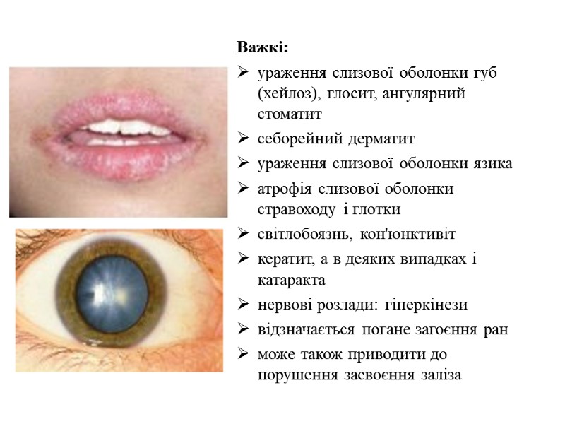 Важкі: ураження слизової оболонки губ (хейлоз), глосит, ангулярний стоматит себорейний дерматит ураження слизової оболонки
